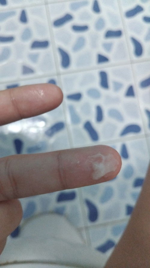 มูกหรือน้ำในช่องคลอด