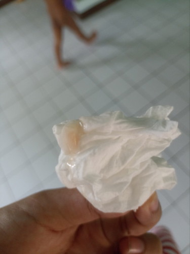 38+6มีมูกแต่ไม่ปวดท้อง