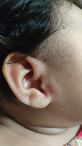 Fluid colorless discharge SA ears SA left side.Natulo po Ng kusa.Medyo my slyt na Amoy.Anu Kaya Ito?