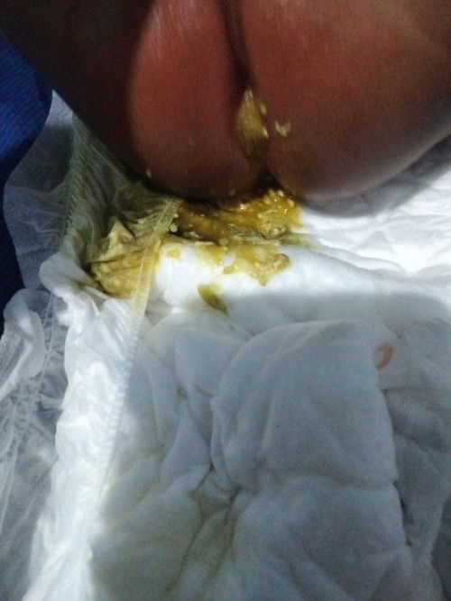 Bayi 5 bulan disentri