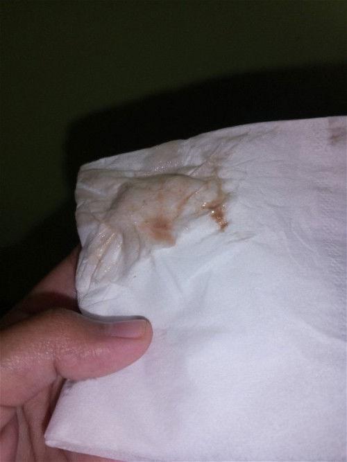 Ada yg pernah diresepin pengencer darah?