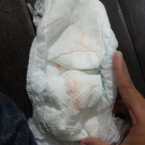 Bercak di popok bayi
