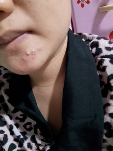 Có mom nào như e hong? bầu mà toàn mụn viêm lên e hong biết làm sao 🥲 tress quá