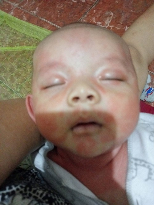 Muncul merah sampe leher