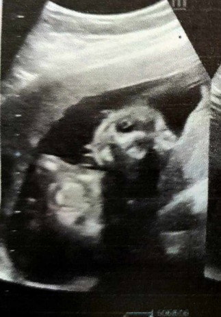 20weeks Ultrasound Scan