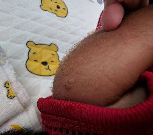 ปลูกฝีแรกเกิด เป็นหนองแตก