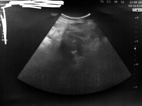 Pregnancy 6 minggu?