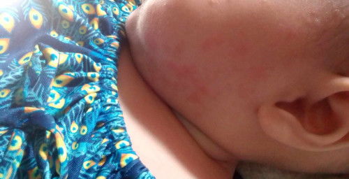 E cũng đã cho bé đ khám và bôi thuốc mà o hết, các m có ai có cách gì hôk hay thuôc gì hữu hiệu o ạ