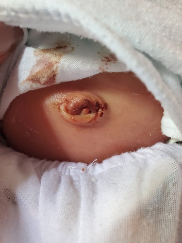 Hello mga mamsh normal lang bah ganito ang pusod ni baby?ngayon lang po natanggal