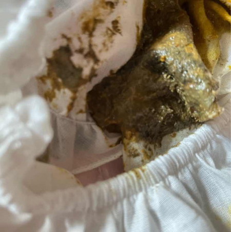 อุจจาระสีดำปน