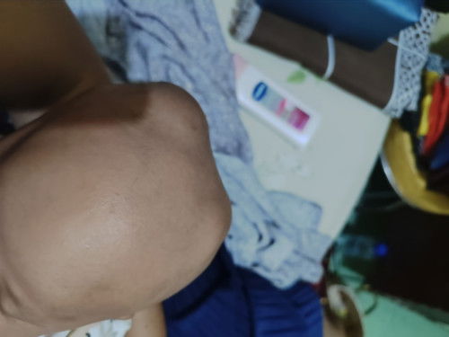 Adakah bunda2 disini yg kepala anaknya terdapat Cephalhematoma seperti ini?