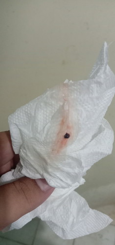 กระตุ้นปากมดลูก ตอน40วีค