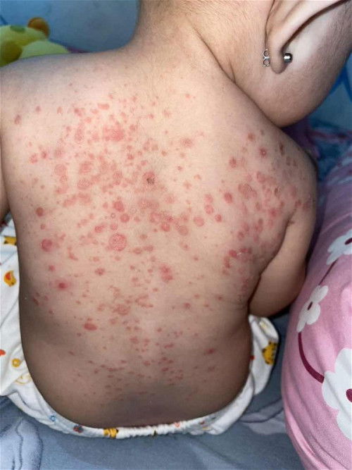 Impetigo pada bayi 9 bulan