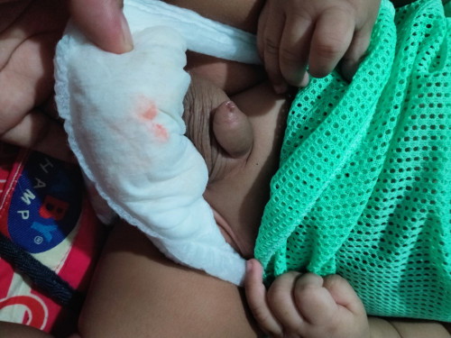 ฉี่เป็นสีชมพู
เด็ก 3 เดือนนะค่ะ