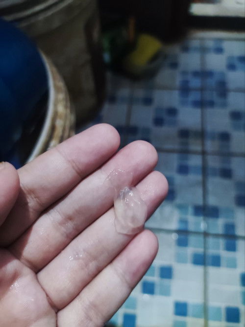 Keputihan Tm 3 usia kehamilan 35w