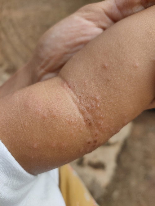 Demam pada anak