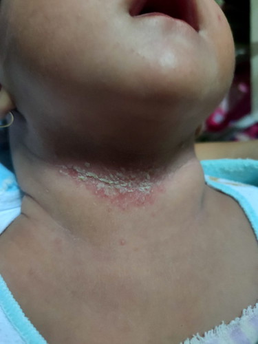 Kulit leher seperti ini, namanya apa ya mom?
