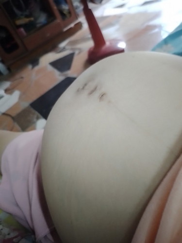 37+4 week แล้ว แม่ๆบ้านไหนมีอาการแบบแม่บ้าง ปวดท้องหน่วงๆ ท้องแข็งบ่อย ระแวงกลัวคลอดแล้วคะ