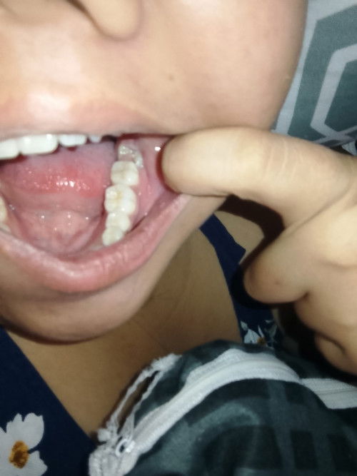 Sirang ngipin sa bagang may tumubo