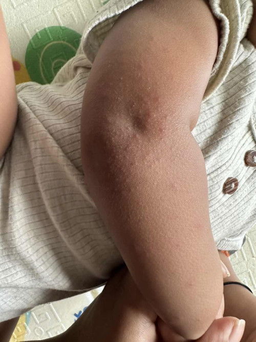 Ruam kat tangan baby