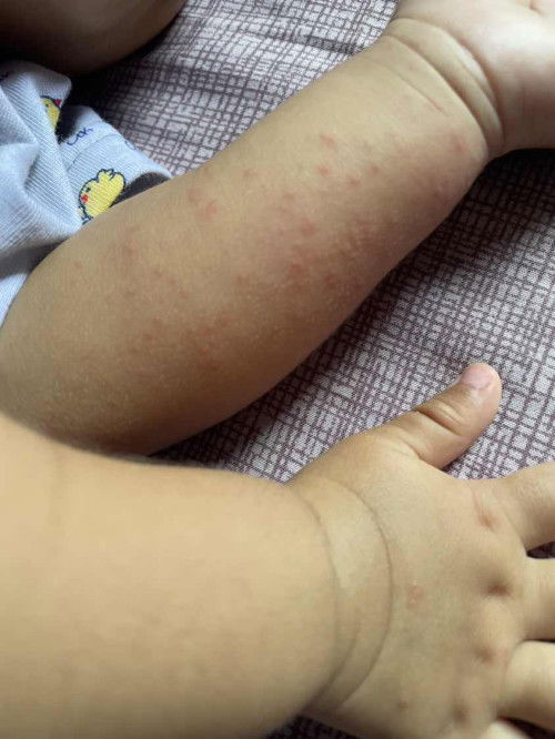 Bintik pada bayi 7 bulan