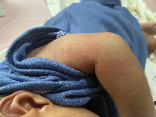 Bintik merah di kulit tangan bayi