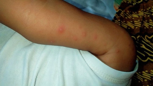 anakku ada bintik bintik di area lengan dan wajah ada beberapa apakah ini termasuk virus singapur