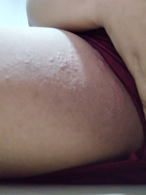 ผืนคันที่ระหว่างขาหนีบ