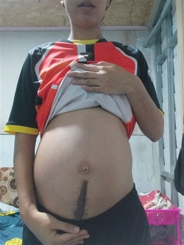 ถ้าผ่าคลอดท้องสองหมอจะเอาคีรอยด์ออกให้ด้วยมั้ยคะ