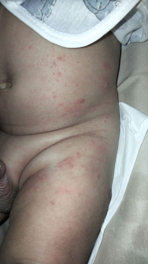 Bunda cara mengataski bayi umur sebulan gatal kayak gini😥