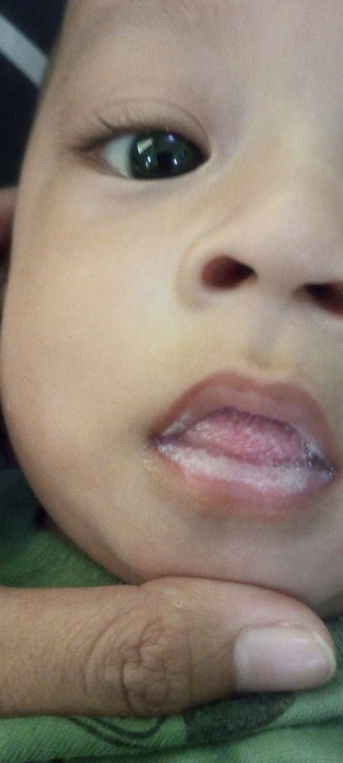 Putih pada bibir bayi dan lidah usia 5 bulan 3 minggu