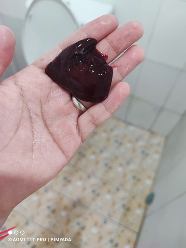 มีเลือดอออกเมื่อเข้านี้