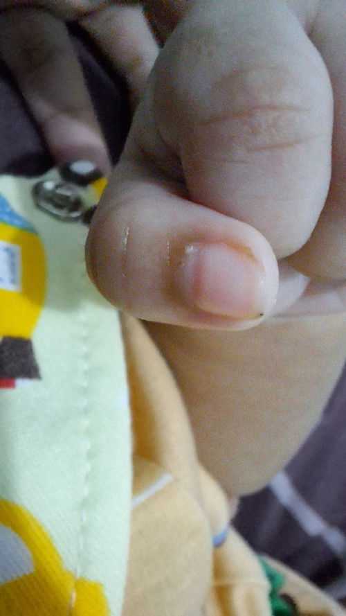 Kalau jari bayi ada bintil kaya gini itu karena apa ya? Dan hilanginnya gimana?