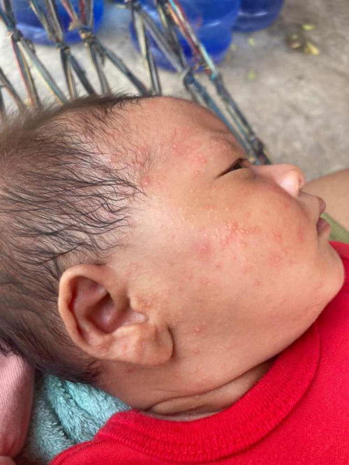 ผื่นร้อนหรืออะไร?