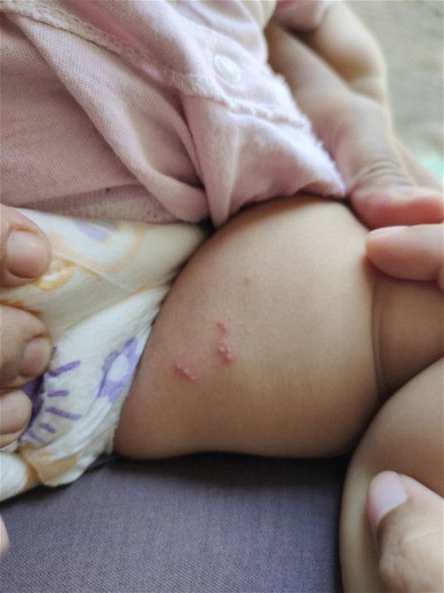 Herpes/dbd/flu singapura?