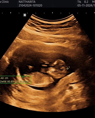 ตั้งครรภ์13w มีเลือดออก