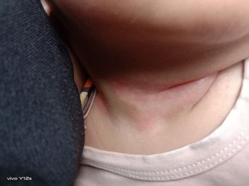 Leher merah  tambah lecet obatnya apa yah bun