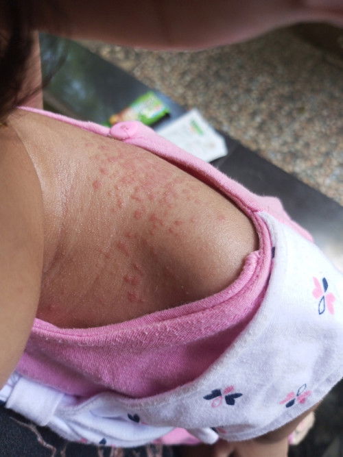 Bun, anakny ada yg ngalamin kaya anakku ga ci gatal² merah