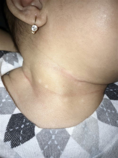 Putih putih seperti jamur kulit di area leher bayi 2 bulan