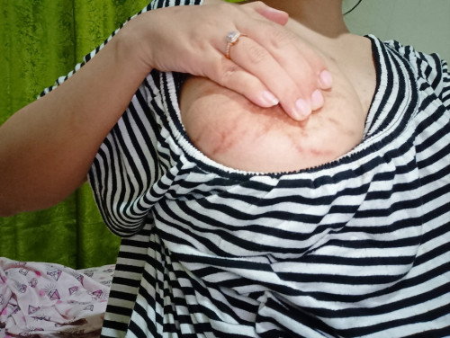 Stretch Mark sa Boobs