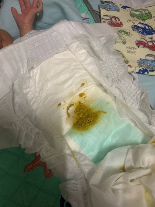 Baby Prem 34 Days - 1.80kg