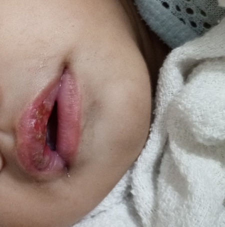 Mga mih anu po bang pwede ipahid sa lips ni baby?