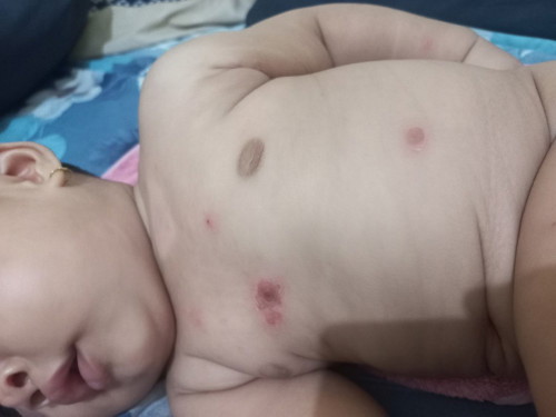 akhir2 ini cuaca panas banget sampai badan anak ada luka mlepuh terus jadi koreng😭