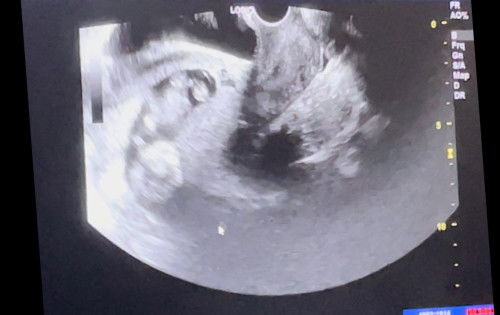 Low Amniotic Fluid at 12 weeks