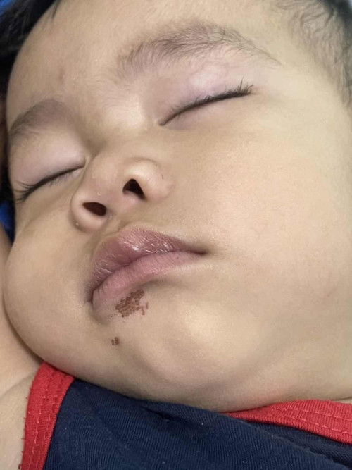 น้องโดนยางมะม่วงกัดใต้ขอบปากด้านล่างจนเป็นแผล