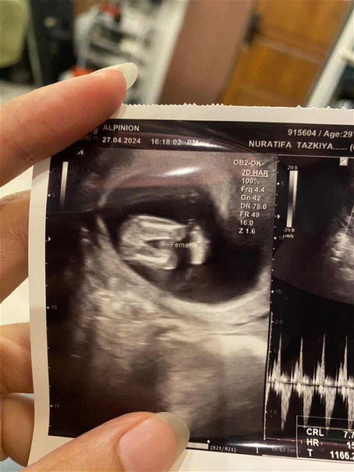 Sharing usg gender baby