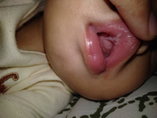 Bercak putih di bibir dan lidah bayi