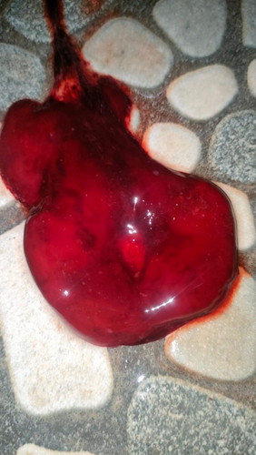 Bun crhat Kndsi kandungan 12w mengeluarkn gmpalan darah 2x ukuran 3cm & 5cm mhn pnglaman nya Bun