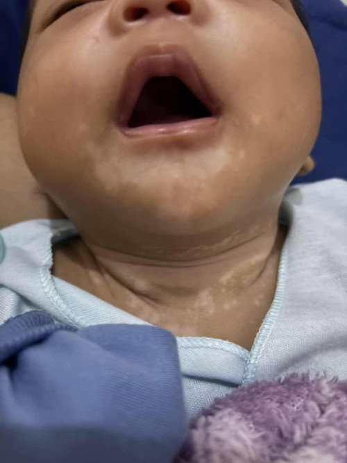 Bercak putih