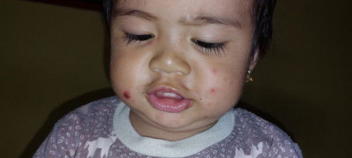 Muka anak timbul bintik² merah